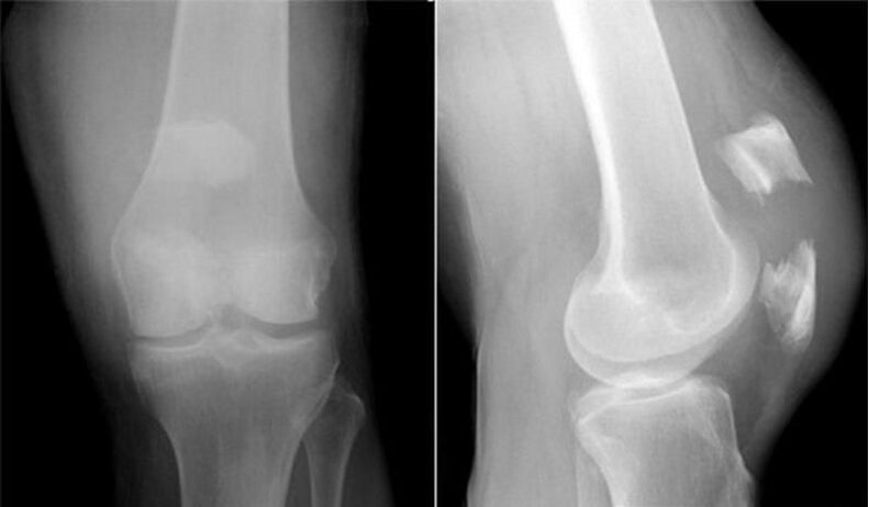рентген на колено
