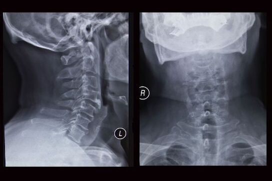 Х-зраци слика на цервикалниот 'рбет (пациентот има остеохондроза)