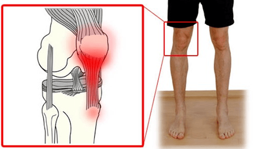 Тендинитис е воспаление на ткивото на тетивата што предизвикува болка во зглобот на коленото. 