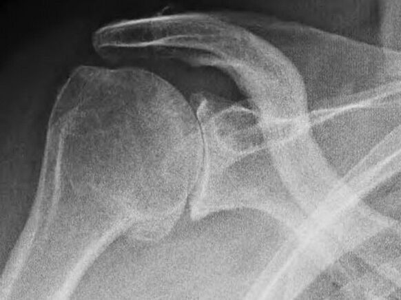 Х-зраци на рамениот зглоб погоден од артроза
