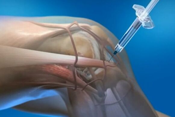 интраартикуларни инјекции за артроза на колен зглоб