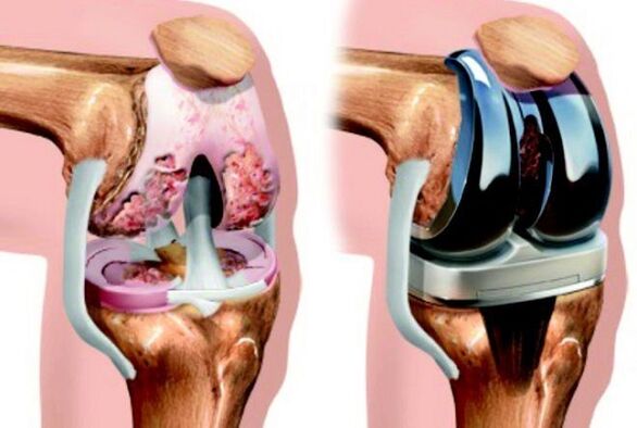 пред и по артроза на колен зглоб за артроза